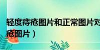 輕度痔瘡圖片和正常圖片對比實物圖(輕度痔瘡圖片)