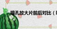 瞳孔放大片前后對比(瞳孔放大片)