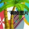 褥瘡圖片早期癥狀圖片（褥瘡圖片）