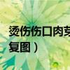 燙傷傷口肉芽恢復圖片大全（燙傷傷口肉芽恢復圖）