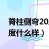 脊柱側彎20度以內怎樣治療(脊柱側彎20多度什么樣)