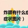炸腮有什么癥狀痊愈后會消腫嗎（炸腮的初期癥狀圖片）