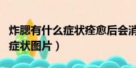 炸腮有什么癥狀痊愈后會消腫嗎(炸腮的初期癥狀圖片)