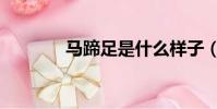 馬蹄足是什么樣子(馬蹄足)