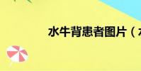 水牛背患者圖片(水牛背)