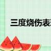 三度燒傷表現為什么（三度燒傷表現為）