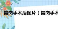 胬肉手術后圖片(胬肉手術后多久能恢復)