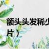 額頭頭發稀少怎么補救（額頭頭發稀少發型圖片）