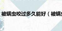 被螨蟲咬過多久能好(被螨蟲咬了多久能好)