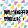 腳趾縫癢開裂潰爛型怎么治療（腳趾縫癢潰爛裂縫圖片）