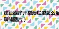 腳趾縫癢開裂潰爛型怎么治療(腳趾縫癢潰爛裂縫圖片)