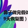 鼻子做完假體后應該注意什么（鼻子做完假體9天恢復圖）
